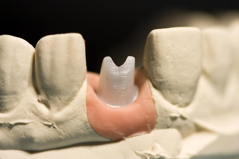 Implant Restoration Vancouver, WA