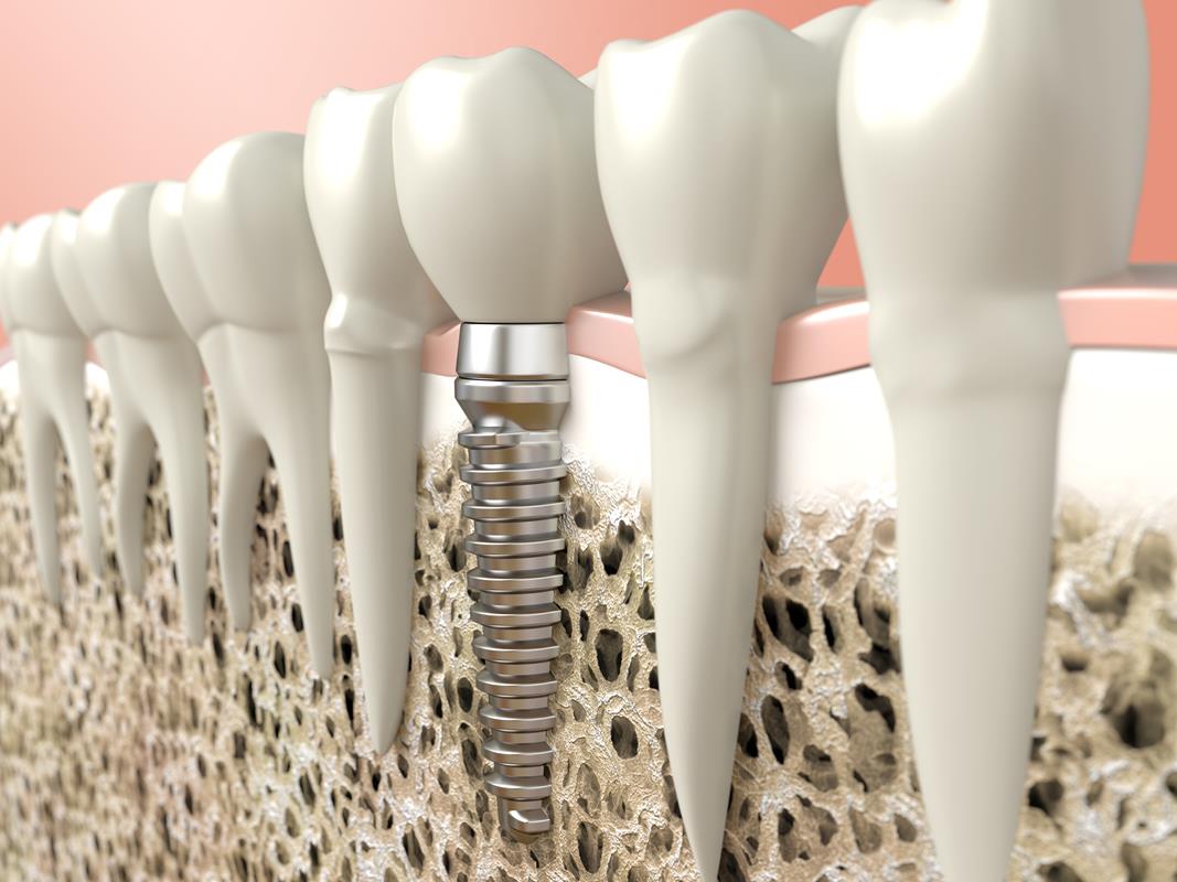 Dental Implants Vancouver, WA