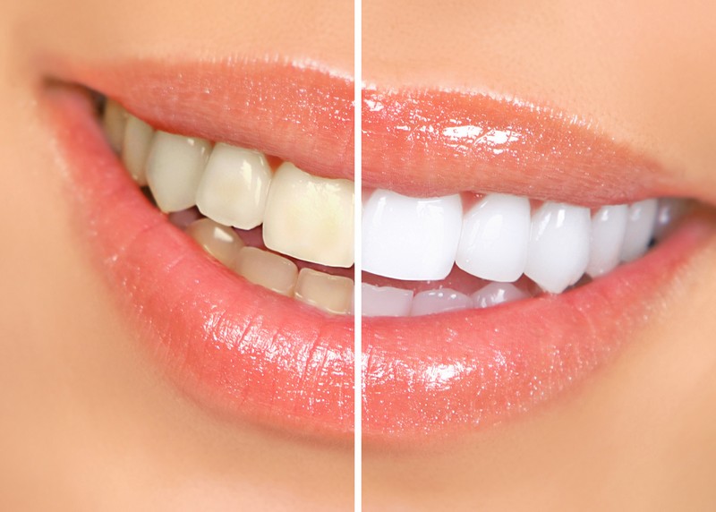 Teeth Whitening Vancouver, WA