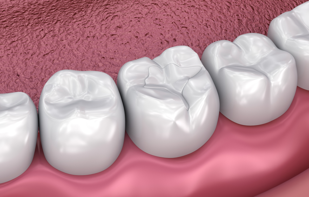 3D illustration of dental sealants