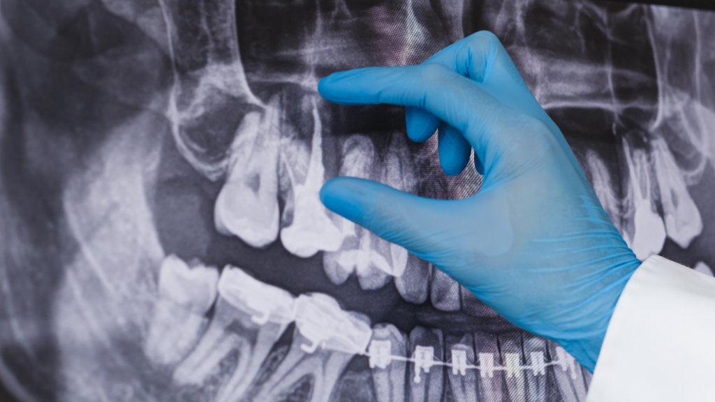 Dentist examining X-rays for root canal treatment