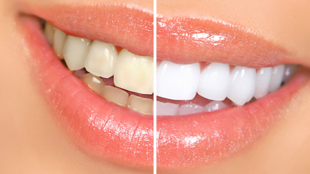 Before and after of professional teeth whitening